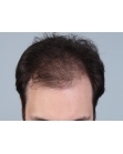 Before Hair Transplant&nbsp;Front
